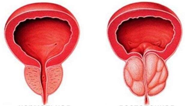 Przewlekłe zapalenie prostaty