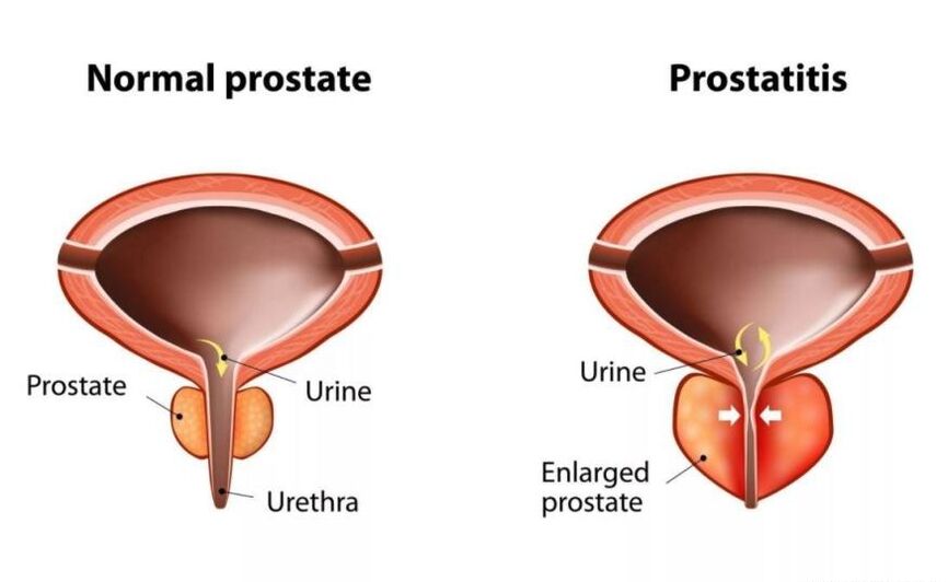 Normalna prostata i stan zapalny